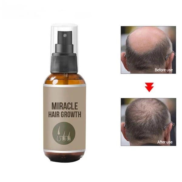 MIRACLE HAIR GROWTH SPRAY - Buy Online 75% Off - Wizzgoo Store