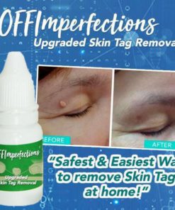 OFFImperfections Upgraded Skin Tag Removal