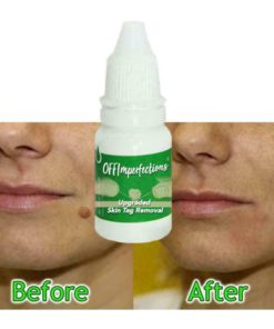 Alternative view of OFFImperfections Upgraded Skin Tag Removal