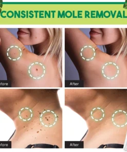 Alternative view of Natural Medi-Grade Tags and Moles Remover