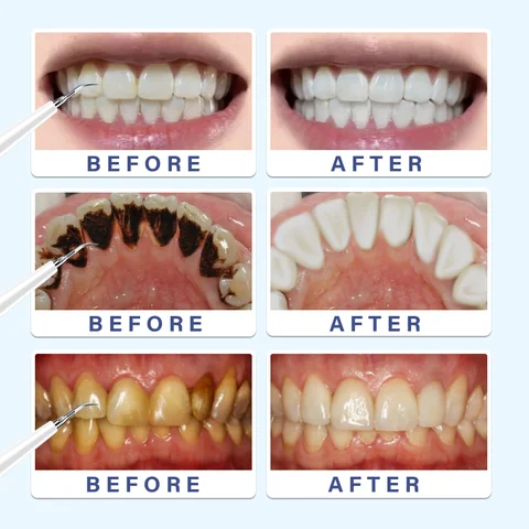 Electric Toothbrush Dental Calculus Remover Kit - Image 9