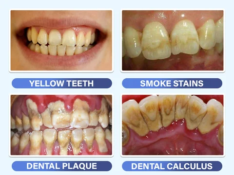 Electric Toothbrush Dental Calculus Remover Kit - Image 7