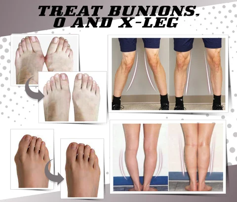Toe Separating Bunion Corrector - Image 3