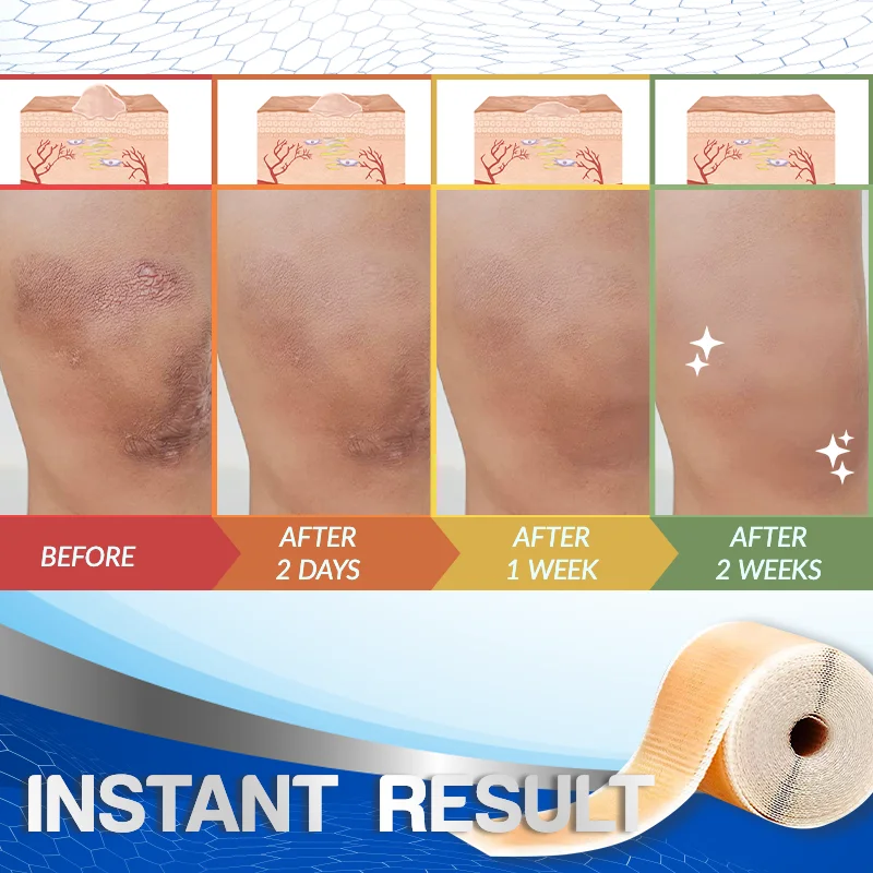 Professional Scar Removal Silicone Tape - Image 5