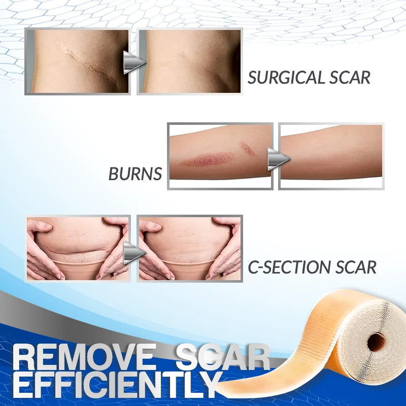 Professional Scar Removal Silicone Tape - Image 4