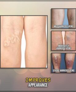 Anti-SpiderLeg Mighty Cream