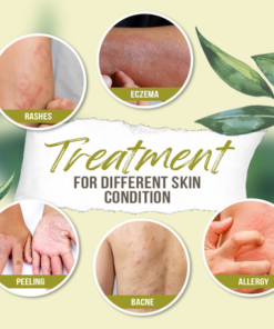 Alternative view of FNB Organic Eczema Herbal Natural Healing Cream