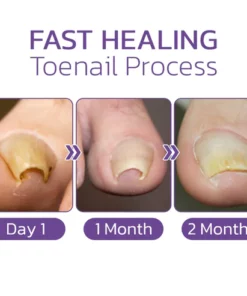 Alternative view of Japanese Elastic Toenail Correction Patch