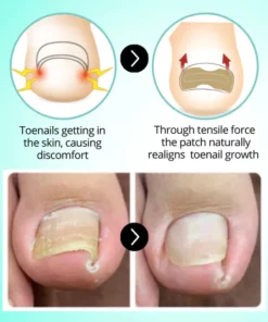 Alternative view of HealPatch Ingrown Toenail Corrector