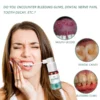 ARERAC Mouth Bleeding-Mouth Ulcers