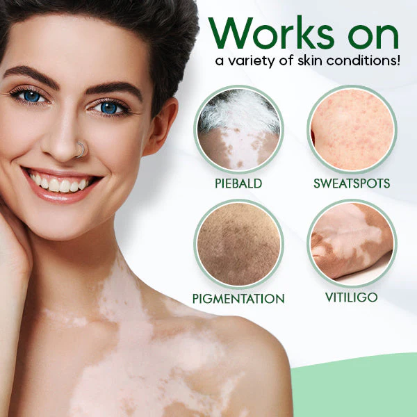 Vitiligo Therapeutic Cream