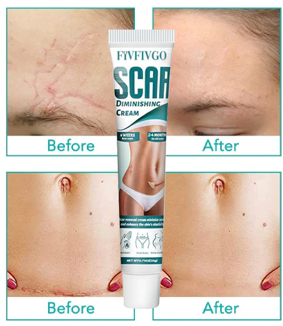 Fivfivgo Scar Diminishing Cream