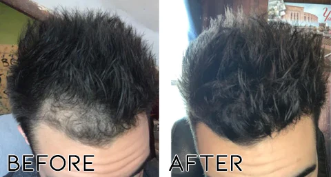 Fivfivgo Minoxidil Hair Regrowth Treatment