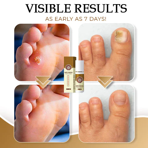 NailCure™ Anti-Fungal Foot Spray - Hoto 4