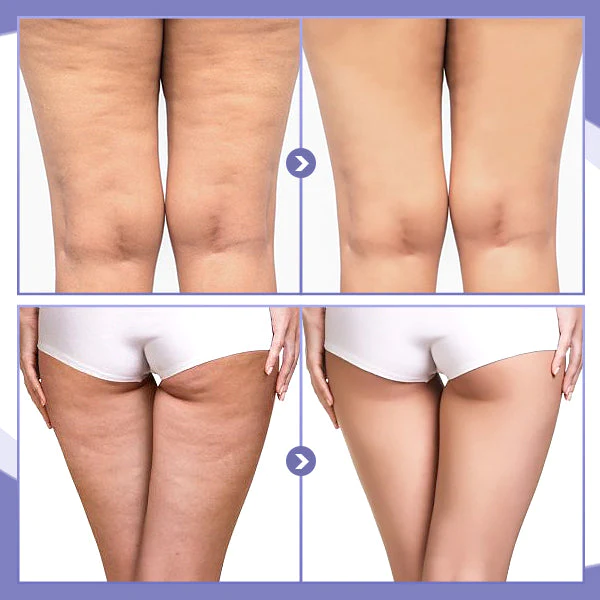 SKINNIER Anticellulite & Tightening Thigh Patch - Image 4