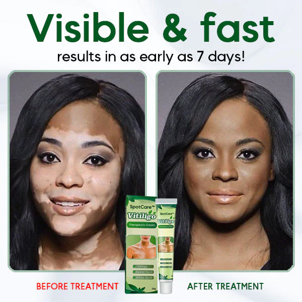 Vitiligo Therapeutic Cream