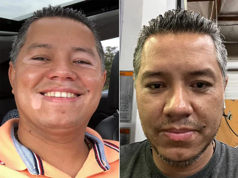 Vitiligo Krema Terapeutikoa - 4. Irudia