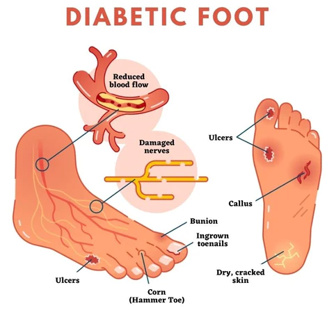 Oveallgo SugarDown Diabetes Foot Pads