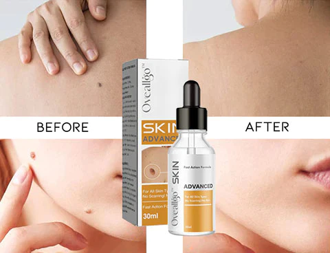 Oveallgo™ Skin Tag garbitzeko esentzia aurreratua - 2. irudia