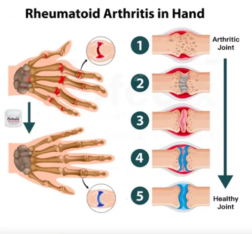CC™ Perfectx artikulazio eta hezur terapia krema - 6. irudia