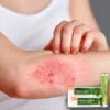 Intensive Eczema Relief Cream