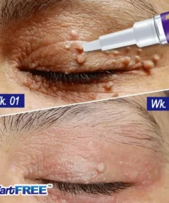 WartFREE™ Common & Plantar Wart Remover