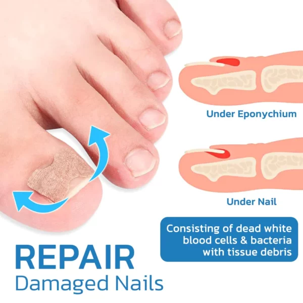 GFOUK™ German ToenailHeal Paronychia Relief Patch - Image 7