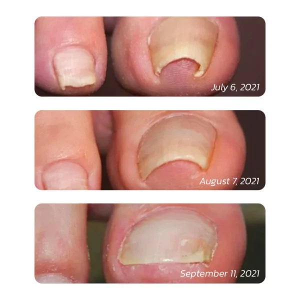 GFOUK™ German ToenailHeal Paronychia Relief Patch - Image 6