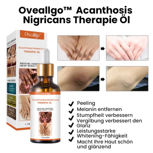 Oveallgo™ Acanthosis Nigricans Therapie Öl