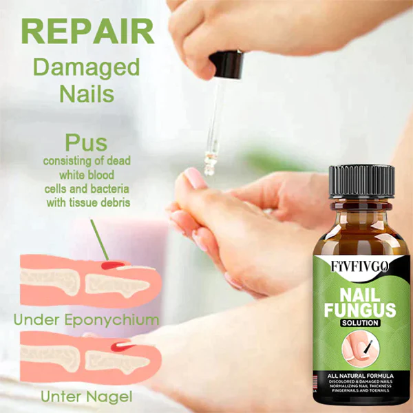 Oveallgo FootCure Removal Paronychia Gel