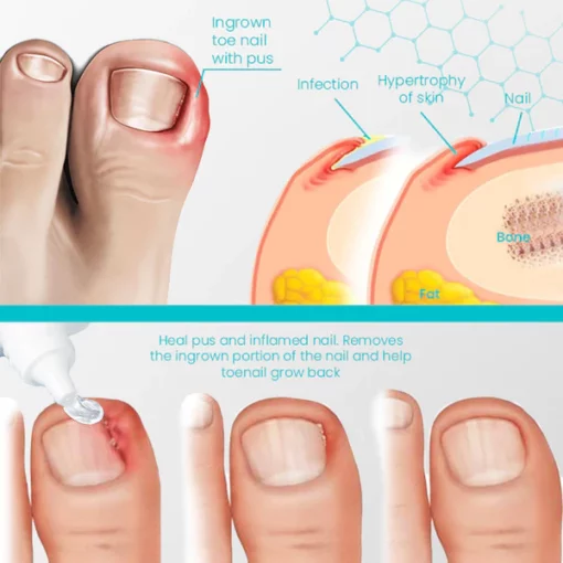 NailRevive™ Psoriasis Recovery Gel - Ofbylding 5