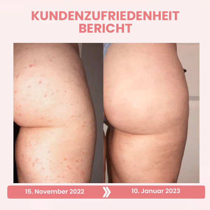 Oveallgo BootyBoost Ultimativ AntiAkne Peeling Natrliche Seife