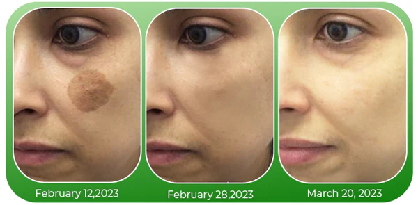 GFOUK German Birthmark Removal Oil