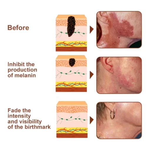 Biancat MarkOut Birthmark Removal Serum