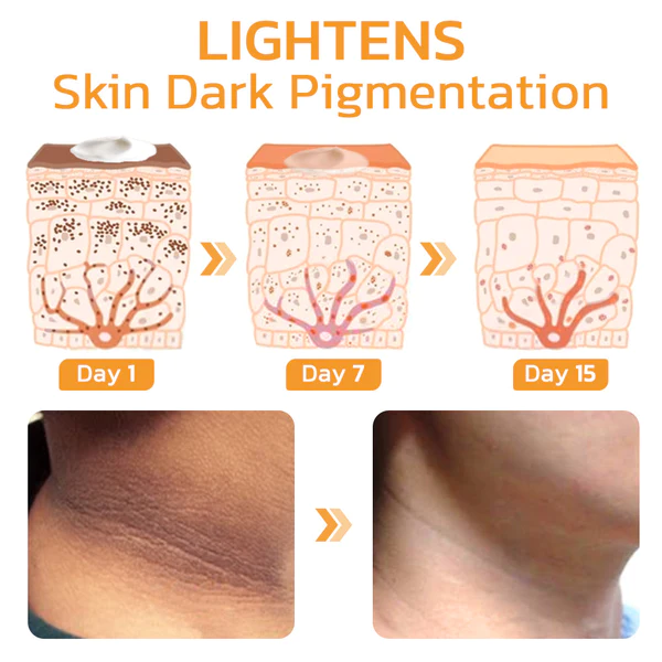 GFOUK FAFASKIN Rckenflecken und Akanthose Nigricans Reinigungslotion