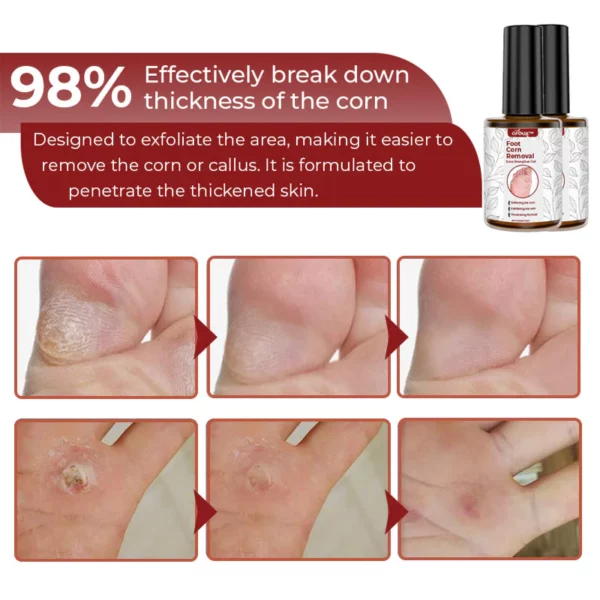 GFOUK Foot Corn Removal Extra Strengthen Gel