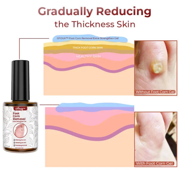 GFOUK Foot Corn Removal Extra Strengthen Gel