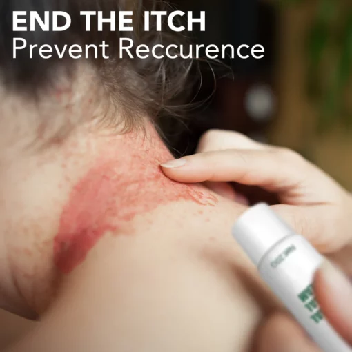 Furzero Hand Ringworm&Tinea pedis Antibacterial Anti-Itch Spray