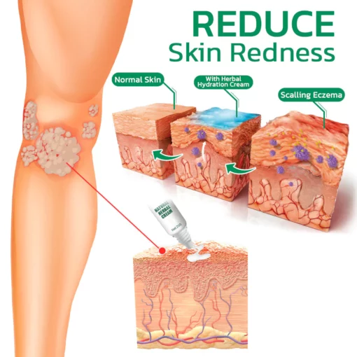 Furzero Hand Ringworm&Tinea pedis Antibacterial Anti-Itch Spray
