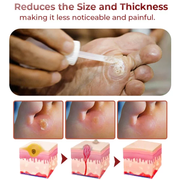 GFOUK Foot Corn Removal Extra Strengthen Gel