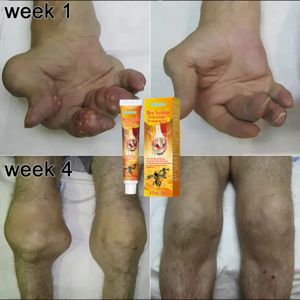 Flashing® New Zealand Bee Venom Professional Treatment Gel - Image 5