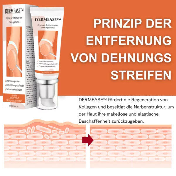 DERMEASE Creme zur Entfernung von Dehnungsstreifen