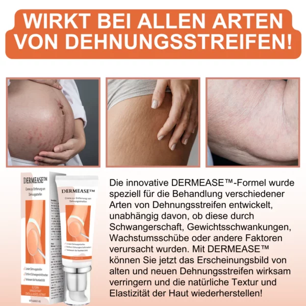 DERMEASE Creme zur Entfernung von Dehnungsstreifen