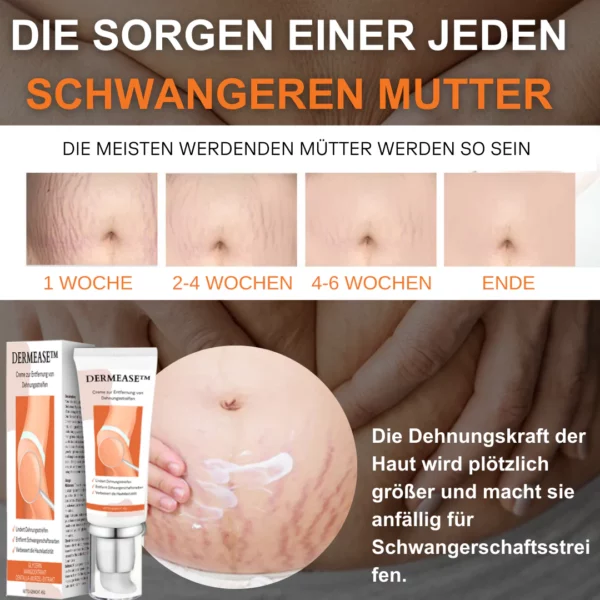 DERMEASE Creme zur Entfernung von Dehnungsstreifen