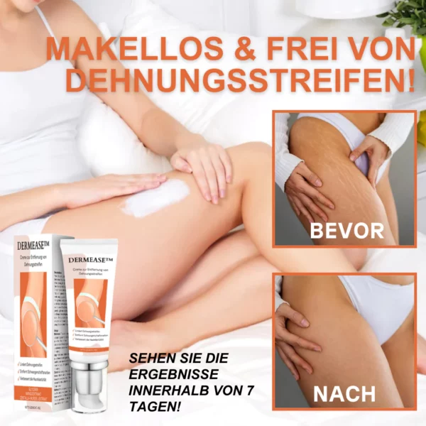 DERMEASE Creme zur Entfernung von Dehnungsstreifen