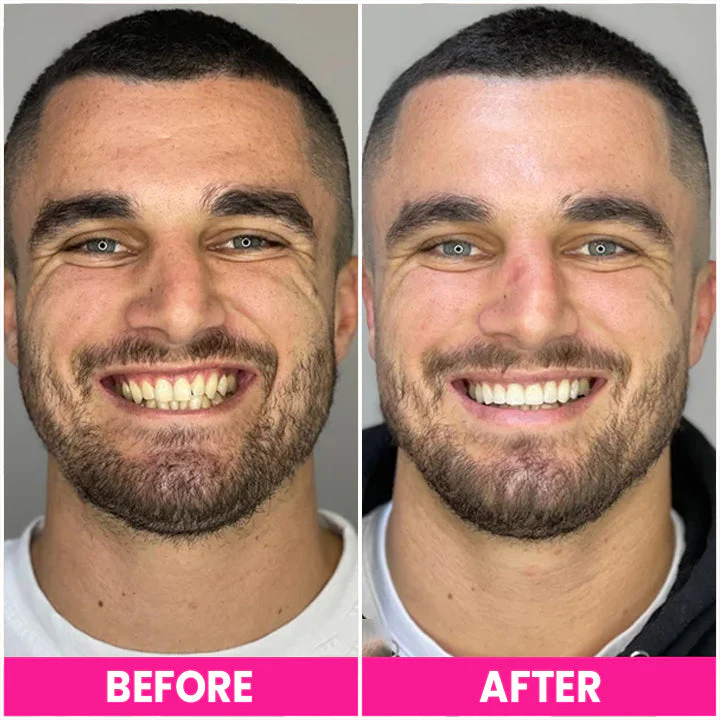 LIMETOW™ Teeth Whitening Pen - Image 8