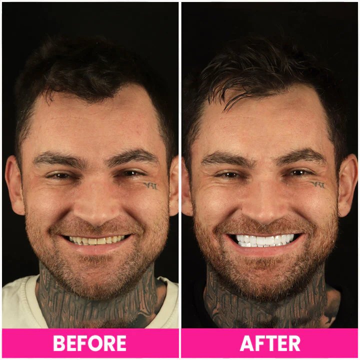 LIMETOW™ Teeth Whitening Pen - Image 7