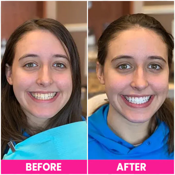 LIMETOW™ Teeth Whitening Pen - Image 5