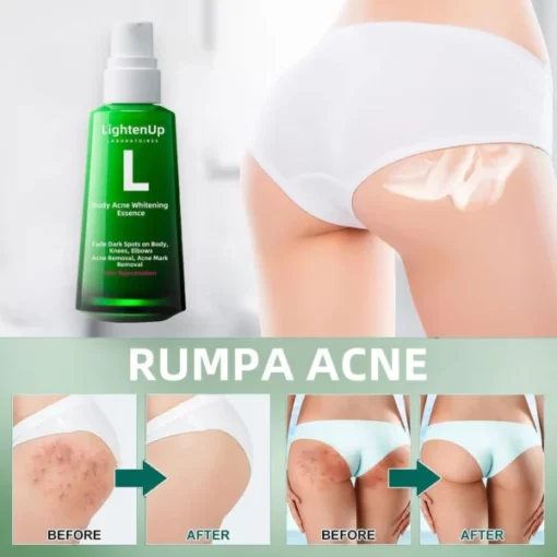 LightenUp™ Buttocks Acne Erasing Serum