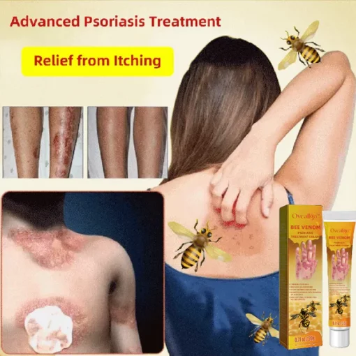 Oveallgo™ krema za liječenje psorijaze od pčelinjeg otrova - Slika 4